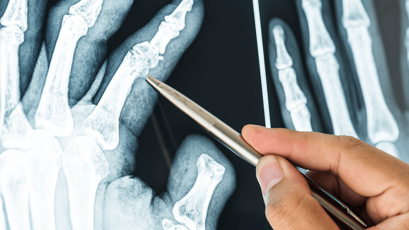 Gãy xương là chấn thương khá thường gặp, có thể do tác động từ lực bên ngoài như té ngã, tai nạn hoặc do các bệnh lý bên trong cơ thể làm tổn thương xương, xương bị yếu dễ gãy như loãng xương, u xương, viêm xương ác tính… 