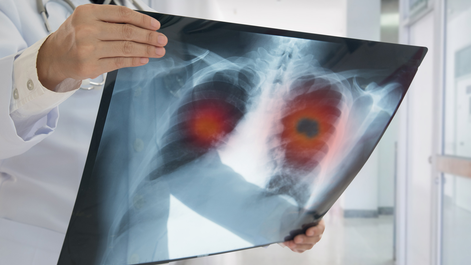 Ngay khi bị phát hiện mắc bệnh ung thư phổi, nhiều bệnh nhân phải đối diện với “án tử” vì bệnh đã ở giai đoạn cuối. Đó là lý do các chuyên gia khuyến khích nên tầm soát ung thư phổi càng sớm càng tốt. 